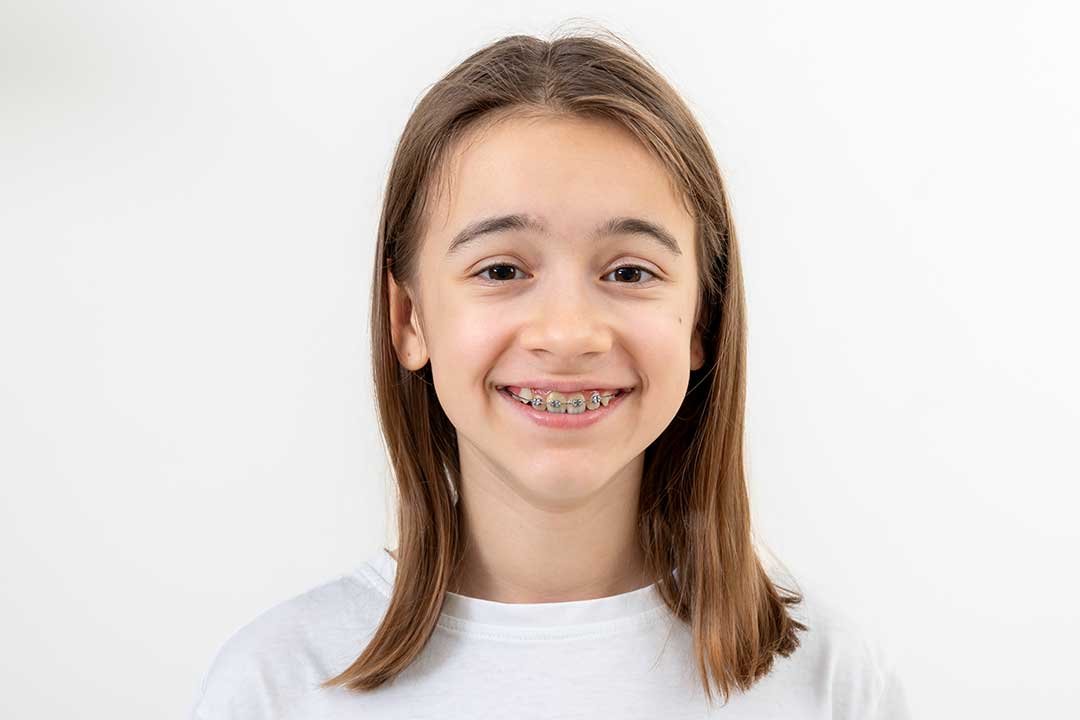 Interceptive Orthodontics: Early Intervention for Lifelong Smiles