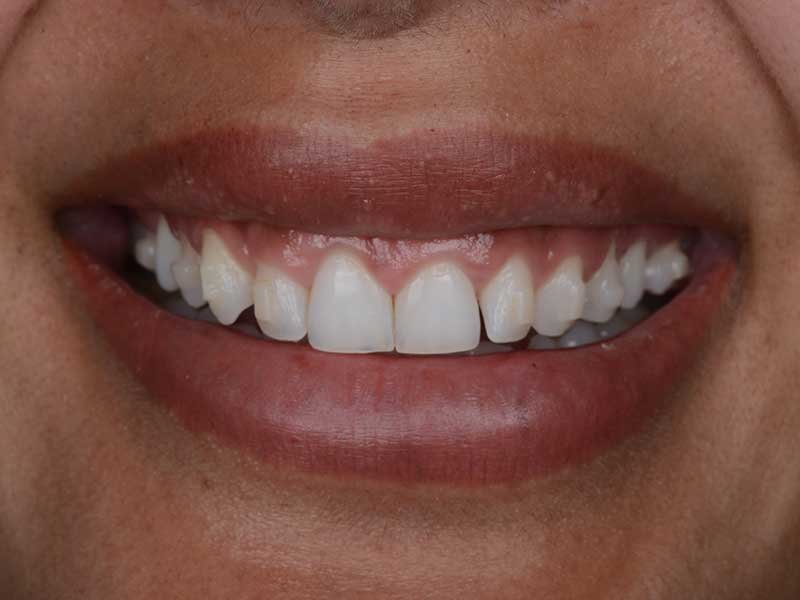 Gingivectomy
